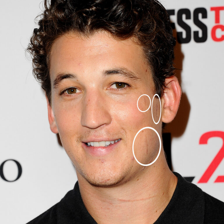 Miles Teller Scars: The Story Behind His Iconic Facial Marks